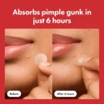 Premium Hydrocolloid Acne Treatment (2026) | Rapid Blemish Removal - Image 4